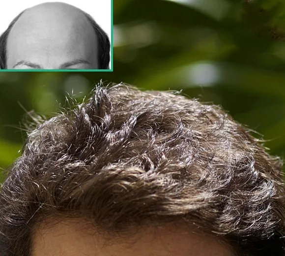 Toupet uomo monofilamento capelli veri o sintetici a Treviso